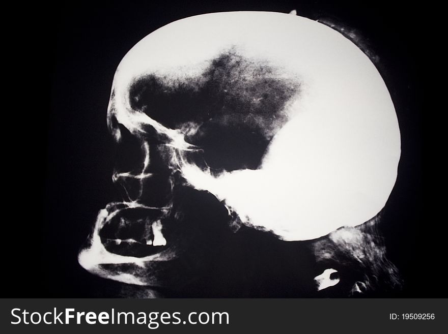 X-Ray of a human head showing the side view.