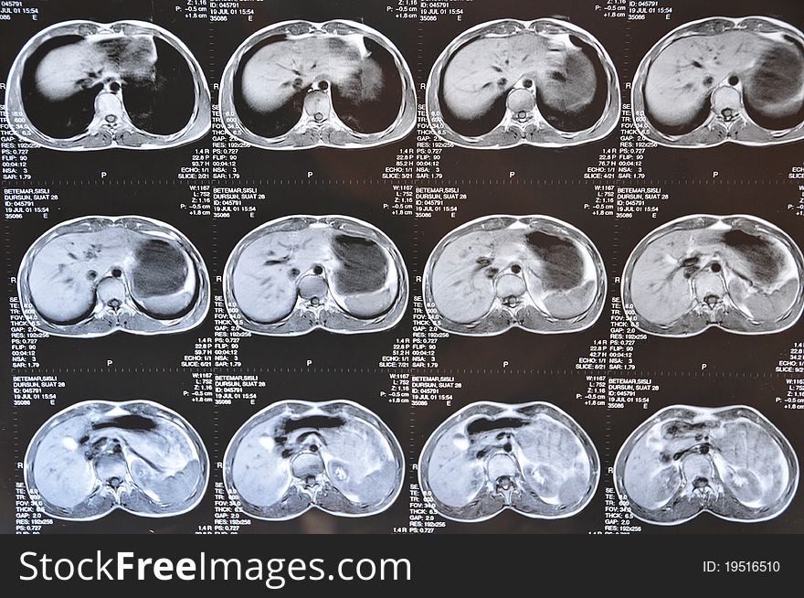 Abdominal MRI image of human body