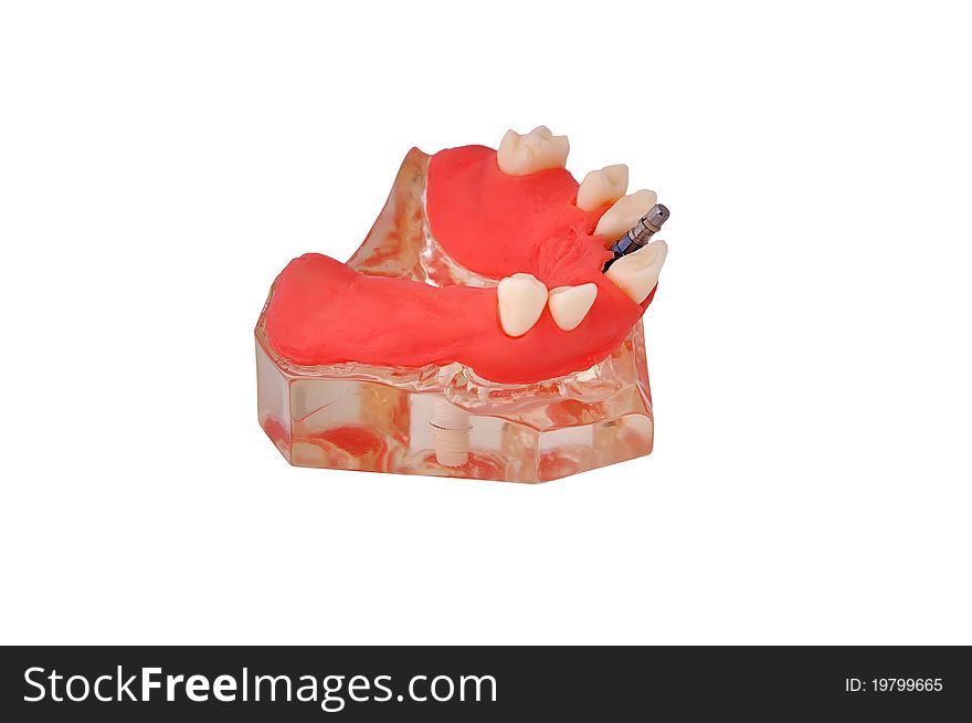 Model of jaw with implant on a white background