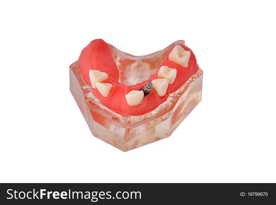 Model of jaw with implant on a white background