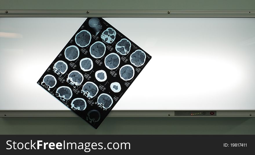 Photo tomogram of the brain, hanging on negatoscope. Photo tomogram of the brain, hanging on negatoscope