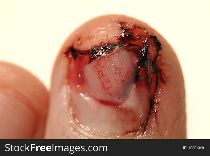 Fingernail Injury