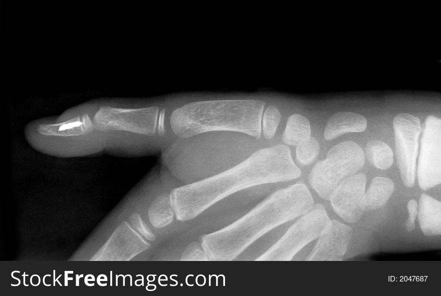 Strange body in human finger on x-ray film. Strange body in human finger on x-ray film