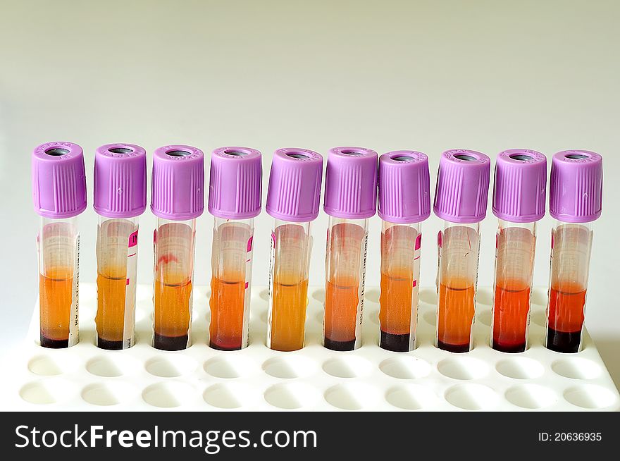 A row of blood sample with purple cap