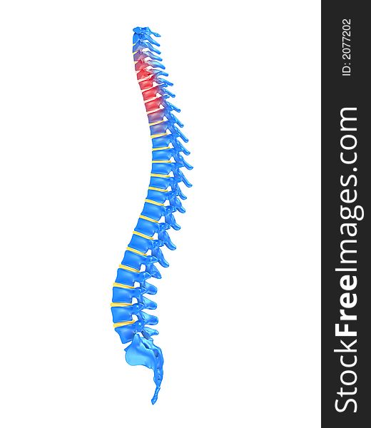 3d rendered anatomy illustration of a slipped disc