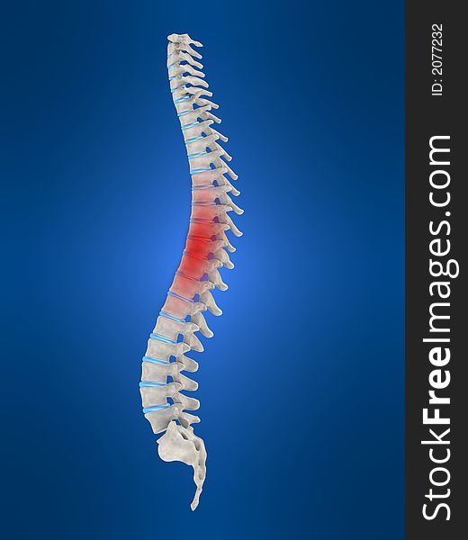 3d rendered anatomy illustration of a slipped disc