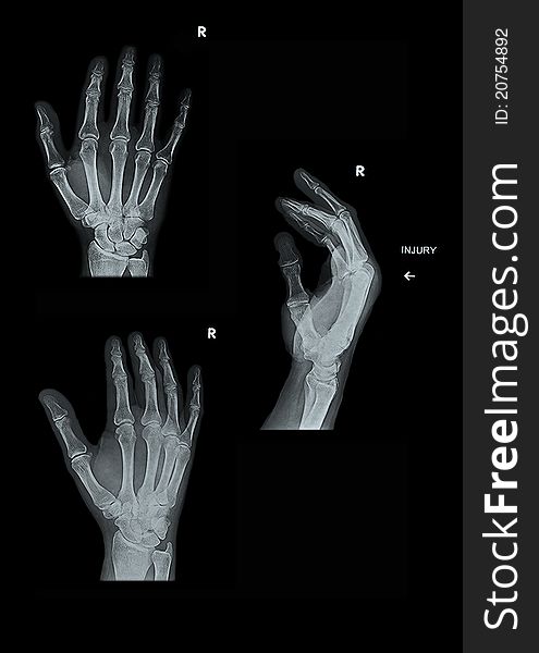 X-Ray set of a right hand with soft tissue showing, 3 views. X-Ray set of a right hand with soft tissue showing, 3 views