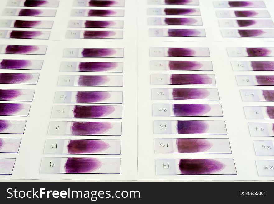 A Blood film waiting for analysis by microscope