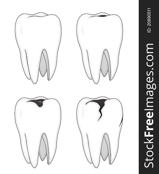 Collection of 4 steps to sequence for a carious tooth