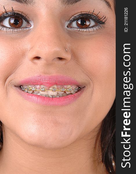 A close-up shot of a teenager face with braises on her teeth and pink lipstick and beautiful eyes. A close-up shot of a teenager face with braises on her teeth and pink lipstick and beautiful eyes.