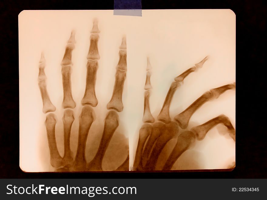 RTG picture, human hands, bones. RTG picture, human hands, bones