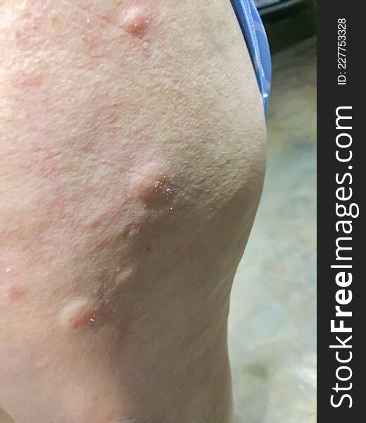 Ill allergy rash dermatitis eczema skin of patient.red rash