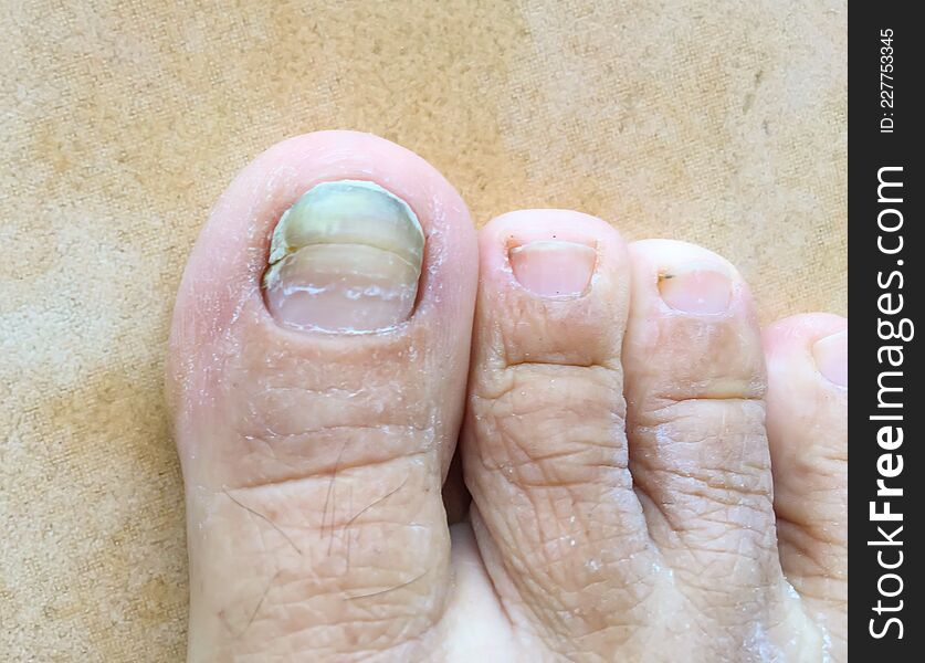 Toe is fungal infection.Medical, treatment, health and medicine concept.Dermatologist