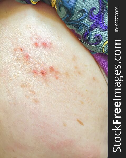 Ill Allergy Rash Dermatitis Eczema Skin Of Patient.red Rash.