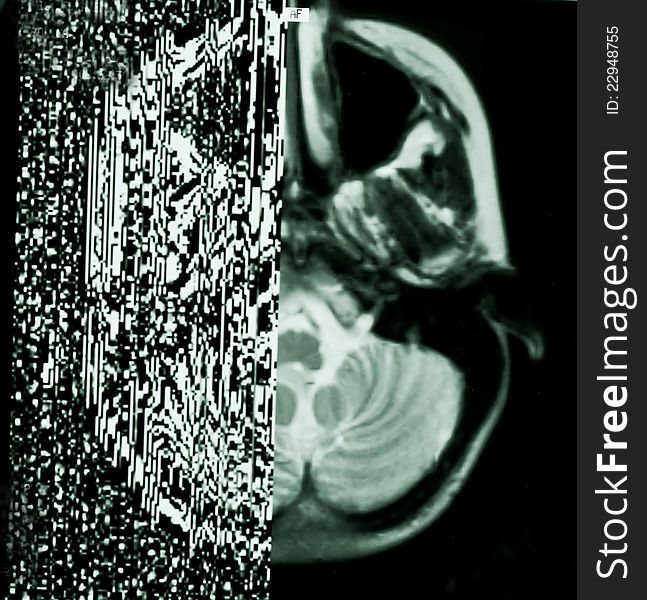 Photo of the transparent laser film with the half of the brain image under heavy error. Photo of the transparent laser film with the half of the brain image under heavy error