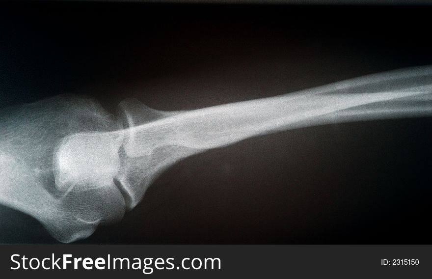 Human X-ray picture of the arm
