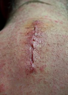 Post Surgery Scar On Back Of Neck Stock Photography Post Surgery Scar On Back Of Neck Stock Photography