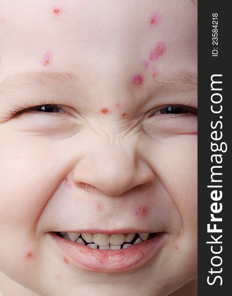 Portrait of a smiling child ailing chickenpox