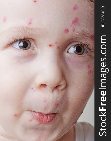 Emotional ill child, close up boy with chickenpox