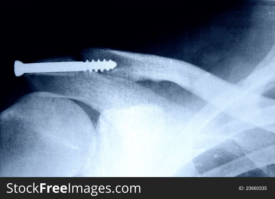 Rengs snapshot of the shoulder joint with a bolt.