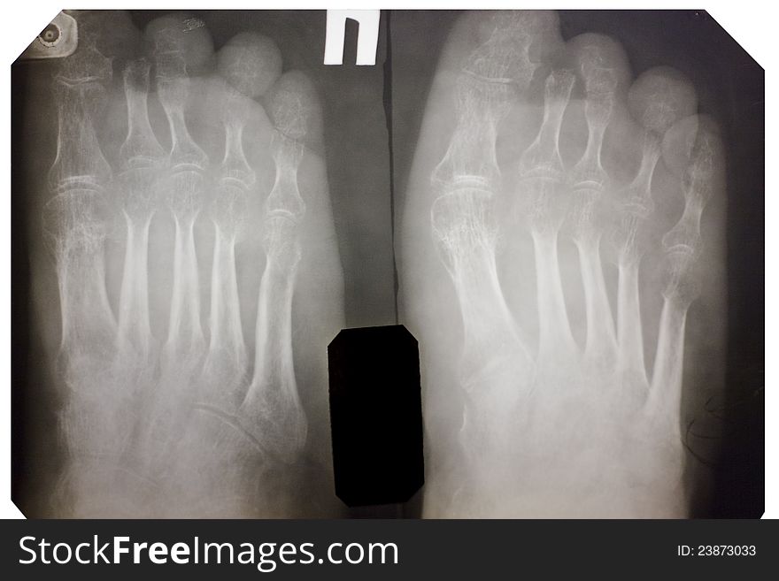 X-ray of the foot. There is no second phalanx of the finger nail.