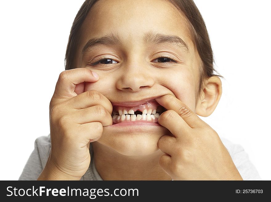 Young girl with missing front tooth on white background