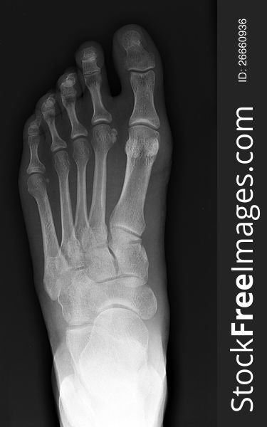 X-ray, top view of a left foot