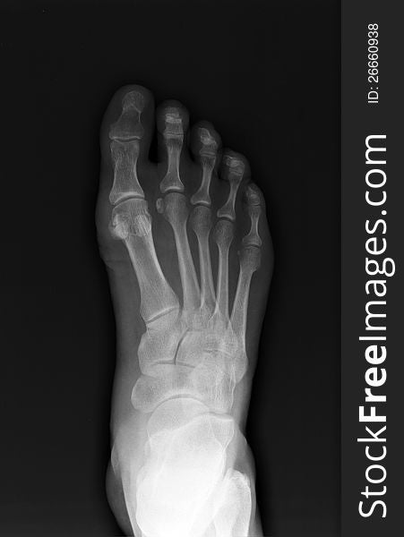 X-ray, top view of a right foot