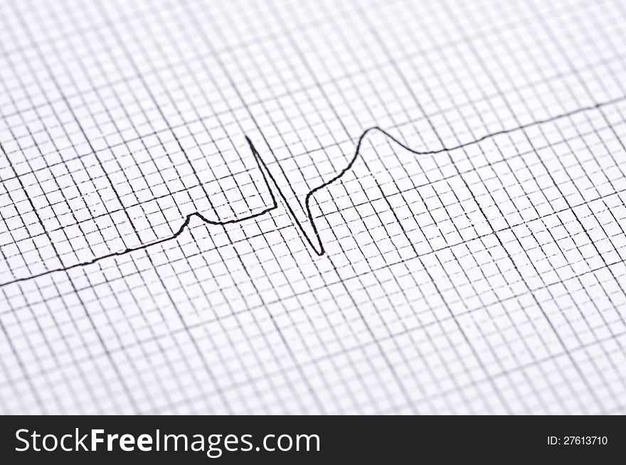 Closeup of twelve lead electrocardiogram graph showing ventrical activation time and amplitude