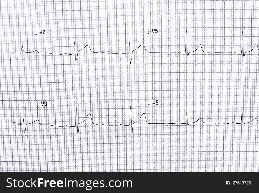 Twelve lead electrocardiogram graph with abnormal first degree AV block
