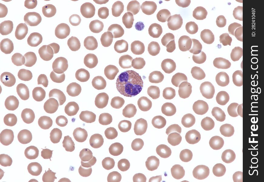 Normal eosinophil in peripheral blood. Wright X1000.