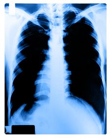 X-Ray Image Of Human Chest Royalty Free Stock Images