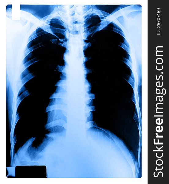 X-Ray Image Of Human Chest, Blue