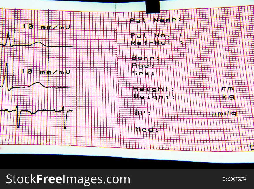 ECG and EKG are conducted on patients. The heart monitoring device produces the sheet. ECG and EKG are conducted on patients. The heart monitoring device produces the sheet.