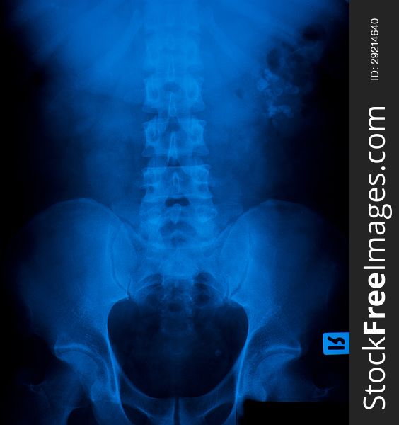 X-ray film of stone in the bladder.