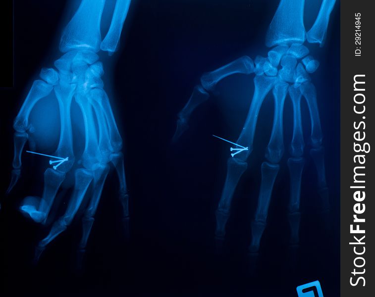 X â€“ ray film of the hand and nails