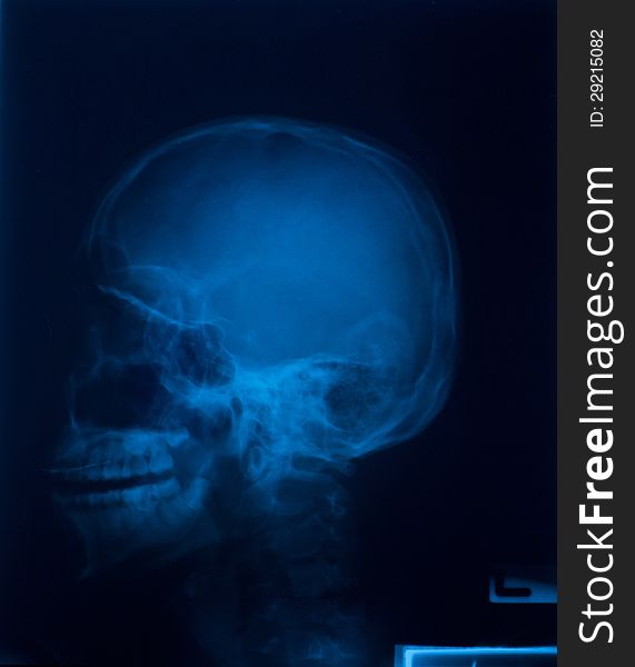 X ray film of skull lateral