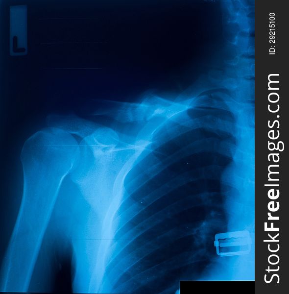 X-ray film of clavicle fracture.