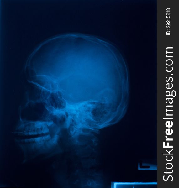 X ray film of skull lateral