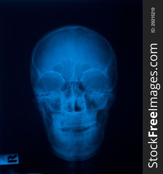 X-ray film of Skull. X-ray film of Skull