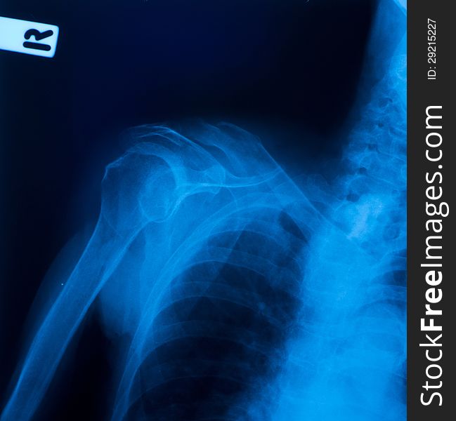 X-ray film of clavicle fracture.