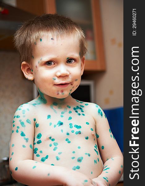 Little boy is sick with chickenpox