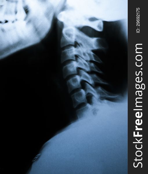 X-ray photograph of human neck bones. Side view. X-ray photograph of human neck bones. Side view.