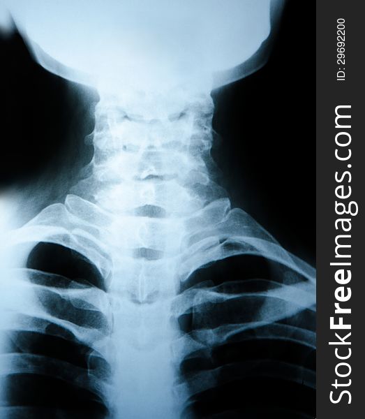 X-ray photograph of human neck bones. Back view. X-ray photograph of human neck bones. Back view.