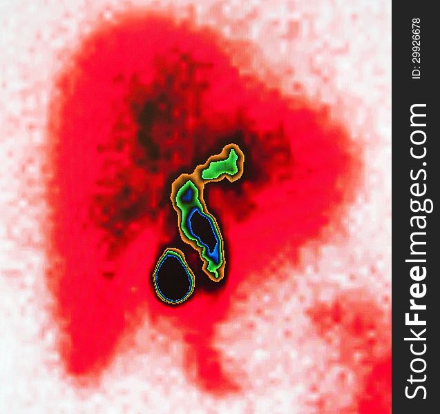 Nuclear hida scan for diagnostic of ejection fraction of gallbladder , liver has red color ,ducts of liver contain green yellow black and blue colors, gallbladder in the form of egg black color ,contour yellow and green. Nuclear hida scan for diagnostic of ejection fraction of gallbladder , liver has red color ,ducts of liver contain green yellow black and blue colors, gallbladder in the form of egg black color ,contour yellow and green