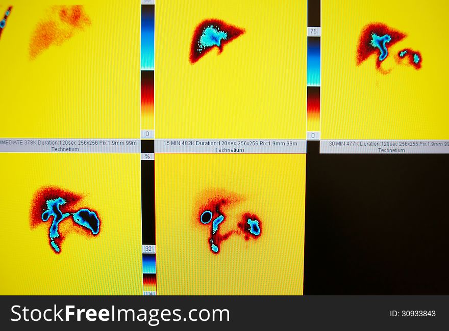 Gallbladder ejection fraction nuclear medicine