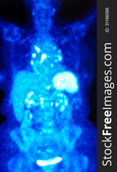 Pet/ct image FDG isotope ,which is very specific for oncological diagnostic. Pet/ct image FDG isotope ,which is very specific for oncological diagnostic