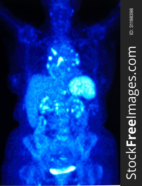 Pet/ct  nuclear medicine