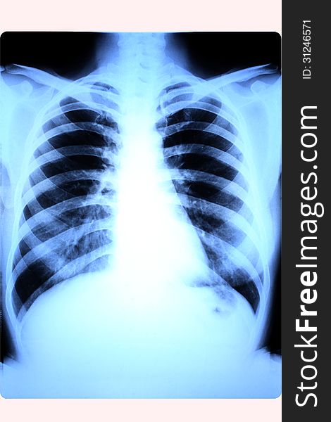 X-ray scan of lungs or female chest. X-ray scan of lungs or female chest