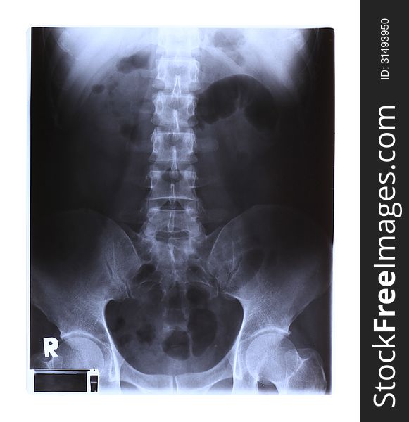 X-ray film of spinal column and pelvis isolated on white background